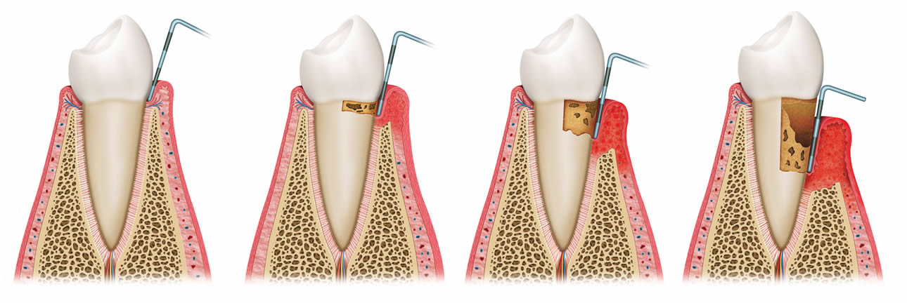 Progression of gum disease
