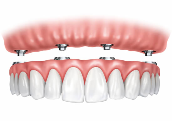 Implant stabilised dentures