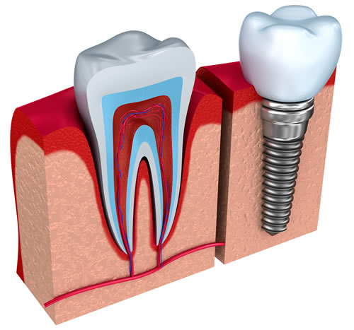 Dental Implant