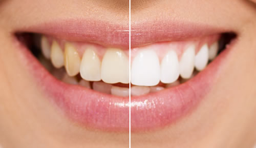 Teeth whitening