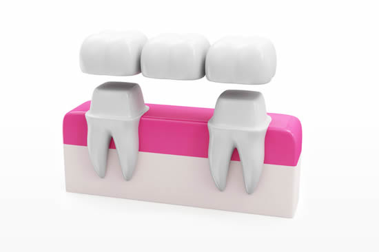 Dental Bridges