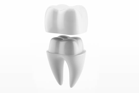 Dental Crown